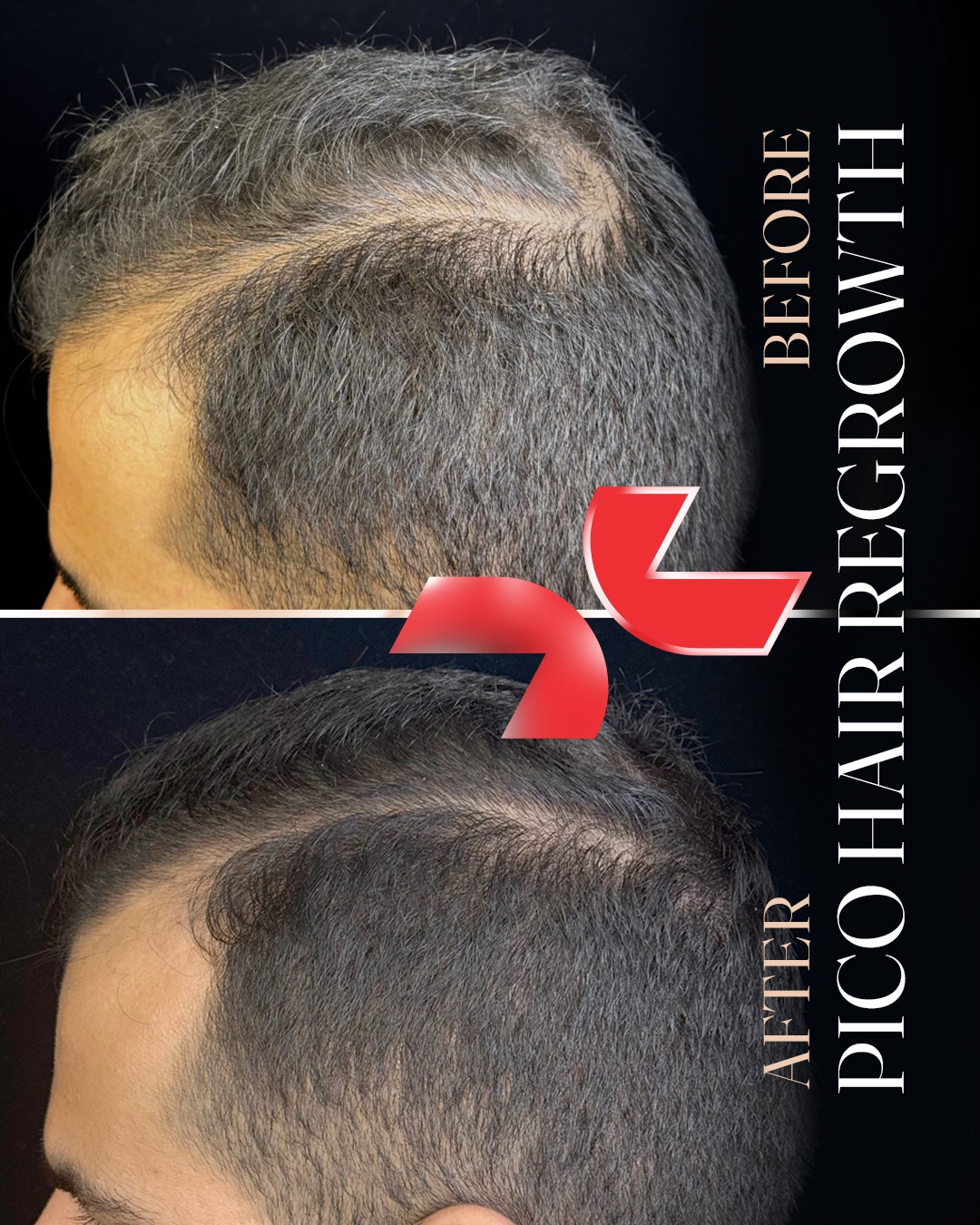 پیش‌نمایش لاغری موضعی